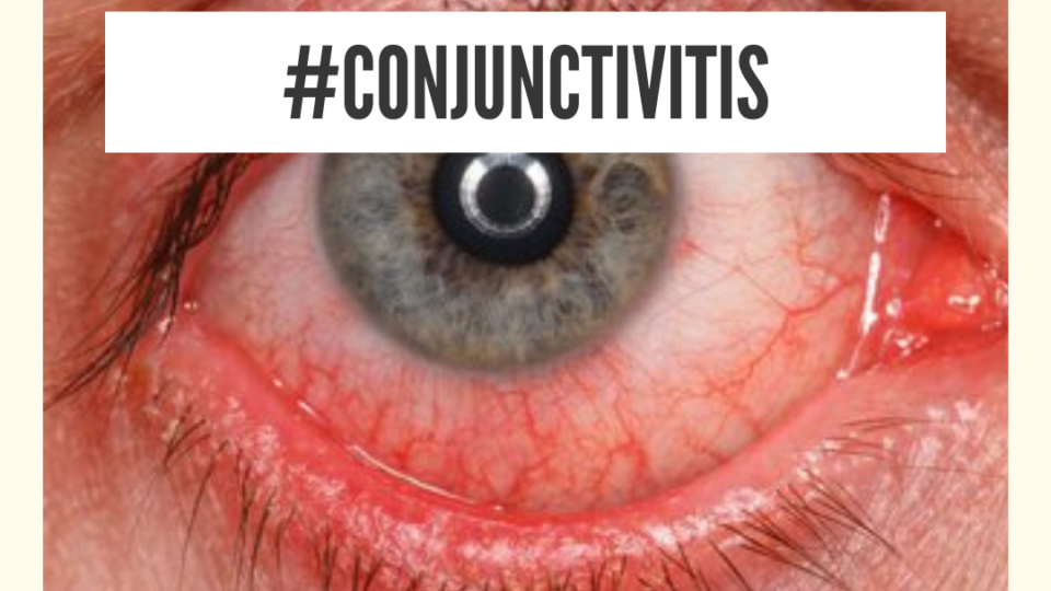 natural home remedy for conjunctivitis