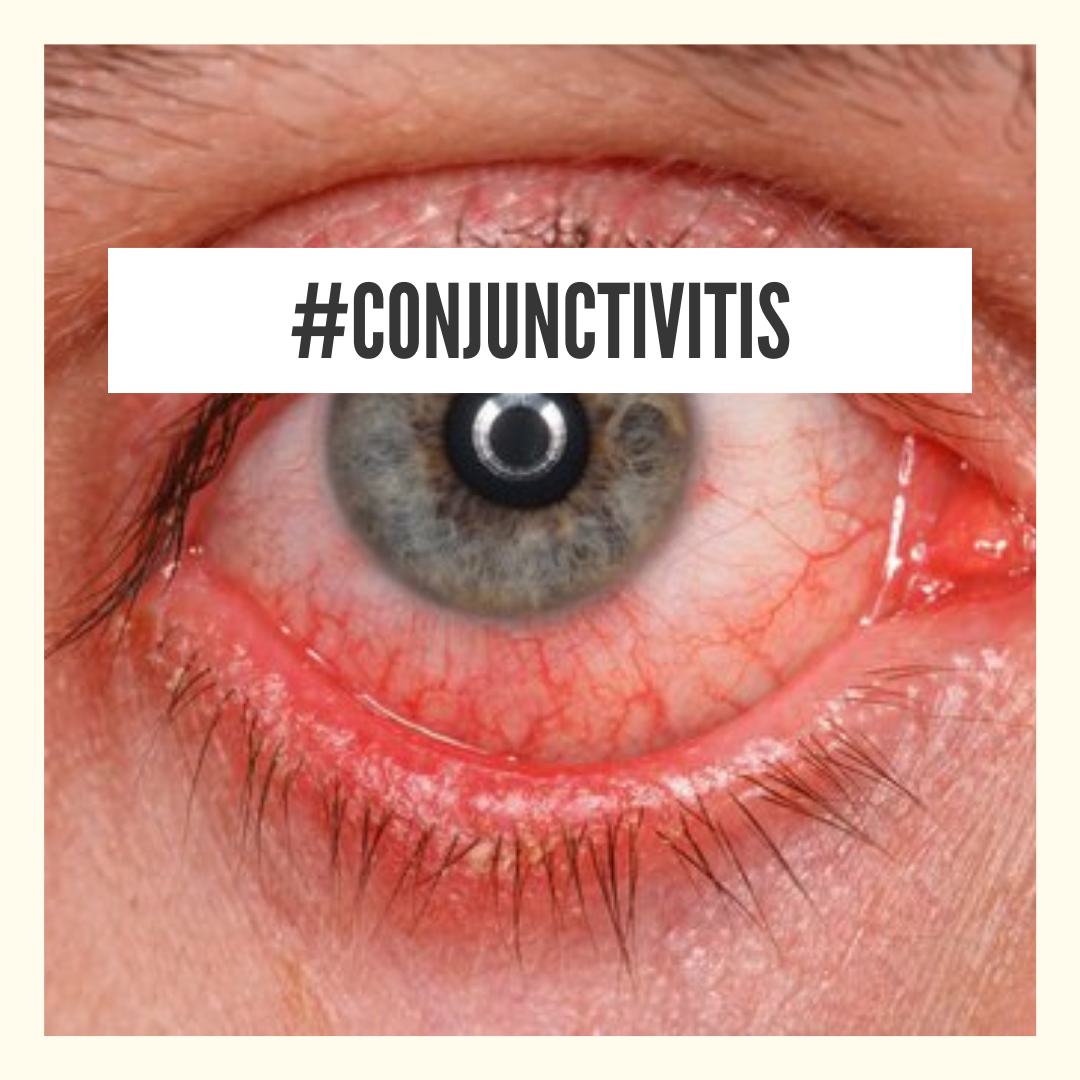 natural-home-remedy-for-conjunctivitis-shittyhealth