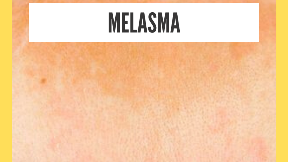 Natural Home Remedy For Melasma During Pregnancy