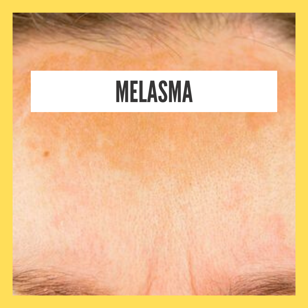 melasma-pigmentation-during-pregnancy-shittyhealth